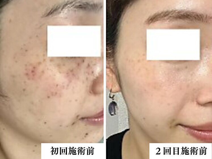 シミケア光フォト1回Before After 産後から気になっていたシミが目立たなく♪