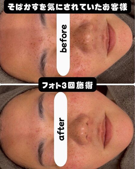 シミケア光フォト3回Before After 幼少期から気にされていたそばかすがここまでここまで綺麗に♪