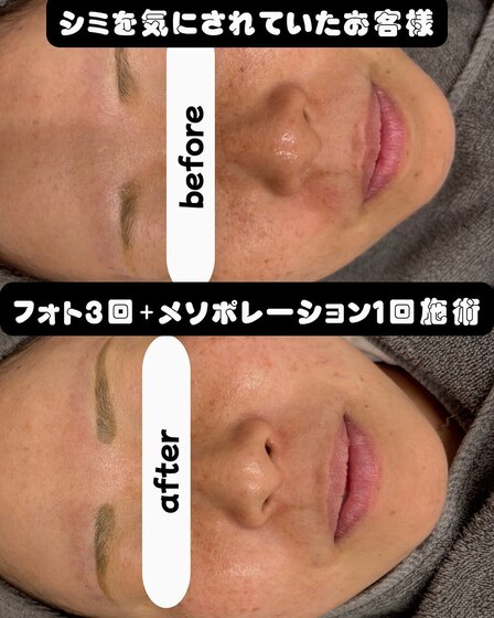シミケア光フォト3回＋メソポレーション1回Before After 全体的にシミ・モヤモヤシミともに薄く♪