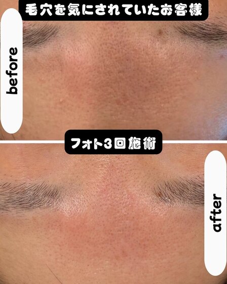 毛穴ケア光フォト3回Before After 眉間の毛穴が目立たなく♪