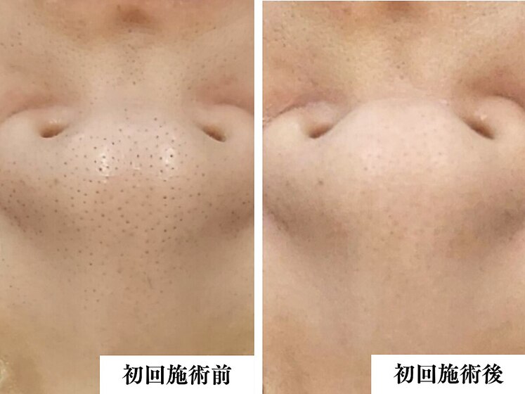 光フォト1回Before After 鼻の黒ずみ毛穴がスッキリ♪
