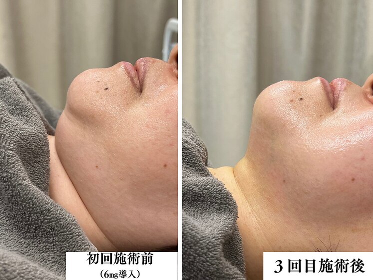 レモンボトル6mg導入×3回Before After フェイスライン・二重顎が別人級にスッキリ♪