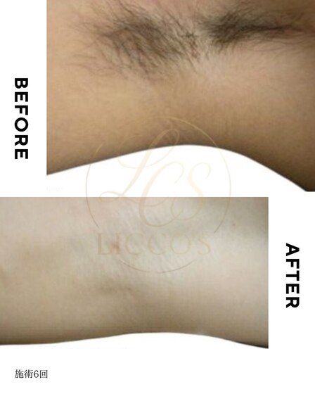 脇脱毛6回Before After 毛が薄くなり、生えるスピードも遅く♪