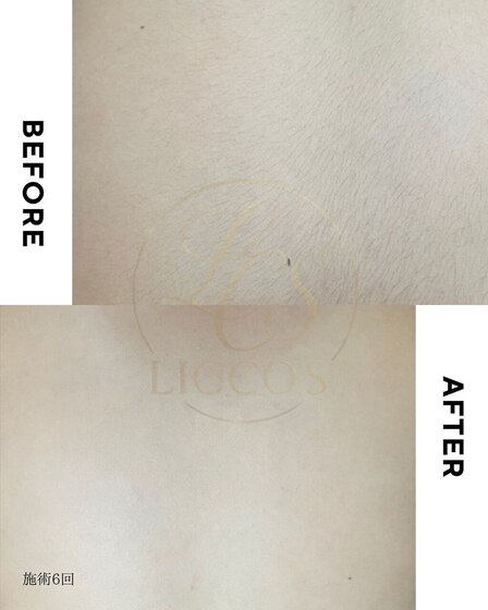 背中脱毛6回Before After 産毛にもしっかりアプローチし、背中の毛が気にならなく♪