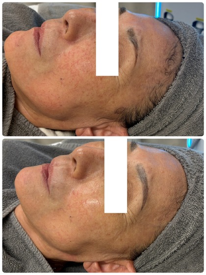 シミケア光フォト3回Before After 60代からでも変われる！シミが薄くなっただけでなく、赤ら顔・血管も目立ちにくく♪お肌全体のハリ・ツヤ感もUPし、明るく若々しい印象に