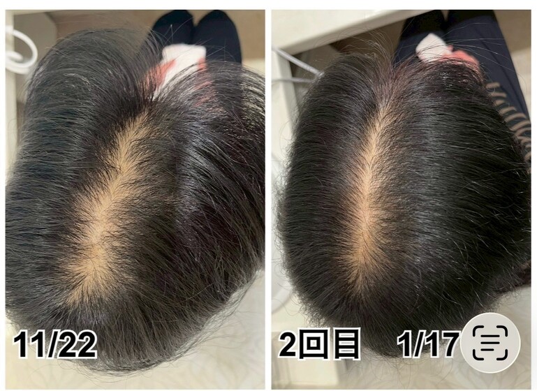 分け目が目立ってきた方も。2回でここまでの変化