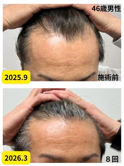 【46歳男性】男性のM字薄毛にも