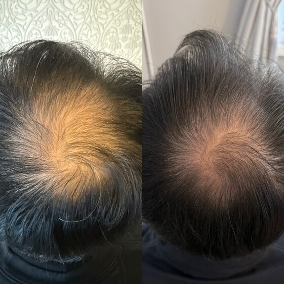 頭頂部の薄毛が気になる方も！