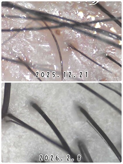 頭皮チェックを行うことで、基礎から改善を導きます。